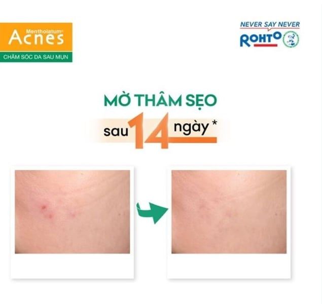 Kem Dưỡng Dạng Gel Giúp Mờ Vết Thâm Mụn Rohto Mentholatum Acnes Scar Care 12g