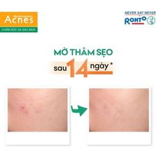 Kem Dưỡng Dạng Gel Giúp Mờ Vết Thâm Mụn Rohto Mentholatum Acnes Scar Care 12g