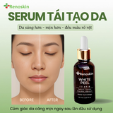  Combo 3 bước xóa nám – sáng da Renoskin | White Peel + B5GF + White Melasma 