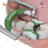  Composi-Tight® 3D Fusion™ Matrix Rings - Khuôn trám xoang II - Cái 