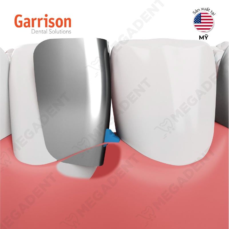  Fusion Anterior Matrix System - Bộ khuôn trám vùng răng trước 