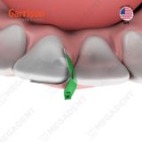  Fusion Anterior Matrix System - Bộ khuôn trám vùng răng trước 