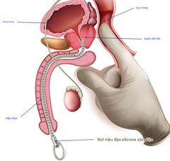 Que Sounding/Thông Tiểu inox 304 Kích thích Niệu Đạo, Đồ Chơi BDSM [Mẫu đầu bo tròn]