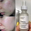 Serum Giảm Mụn The Ordinary Niacinamide 10% + Zinc 1% 30ml