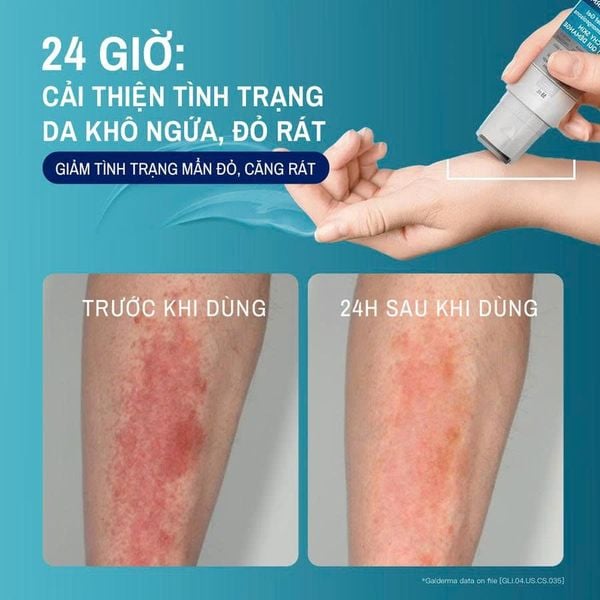 Gel làm dịu và hỗ trợ giảm ngứa cho da chàm, viêm da cơ địa CETAPHIL PRO AD DERMA Instant Relief & Moisturising 59ML