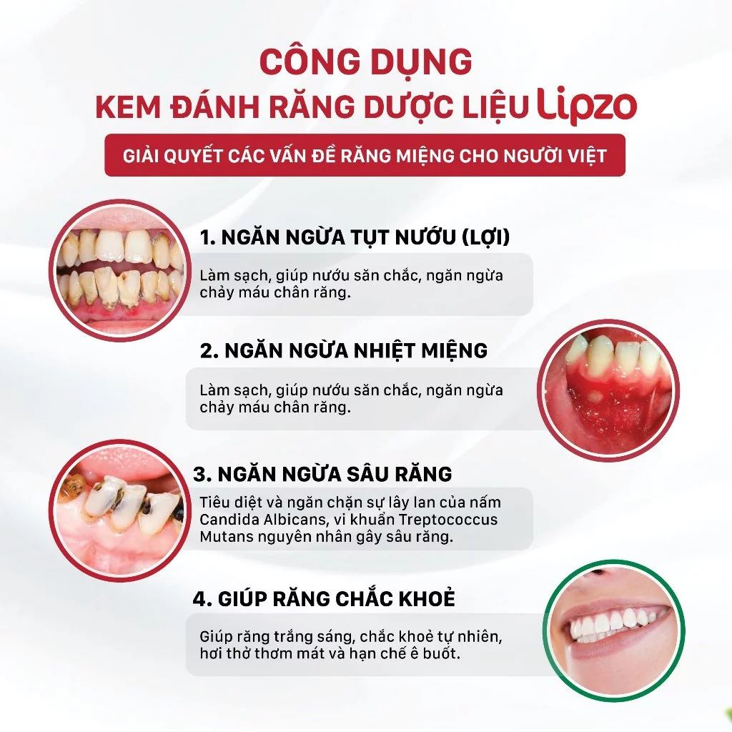  Kem Đánh Răng Lipzo Gum Protect 185g Ngừa Tụt Nướu, Bảo Vệ Chân Răng, Kháng Khuẩn 
