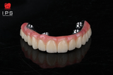  Phục hình hybrid toàn hàm all on x - PMMA 