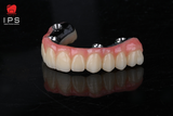  Phục hình hybrid toàn hàm all on x - PMMA 
