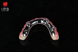  Phục hình hybrid toàn hàm all on x - PMMA 