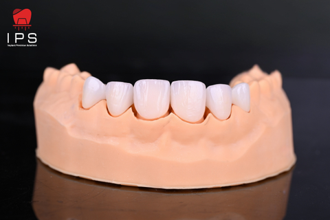  Phục hình thẩm mỹ - Sứ Veneer 