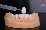  Phục hình thẩm mỹ - Sứ Veneer 