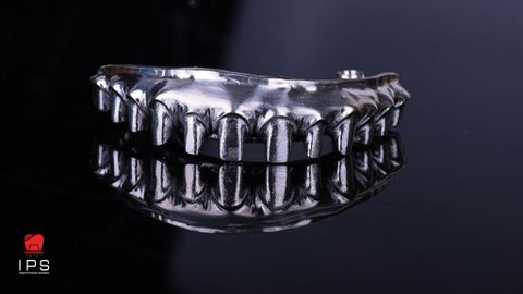  Phục hình thimble toàn hàm all on x 
