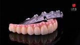  Phục hình toàn hàm hybrid all on x - Zirconia 