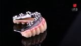  Phục hình toàn hàm hybrid all on x - Zirconia 