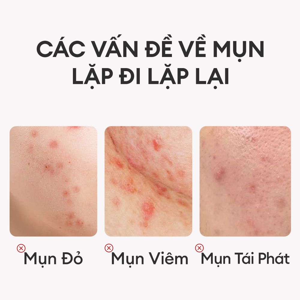 Kem giảm mụn Colorkey luminous Green Tea purifying acne treatment 20g