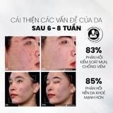  Serum Tẩy Tế Bào Chết Kiểm Soát Mụn, Giảm Viêm Và Giảm Tiết Dầu MD CARE AntiAc Exfo 