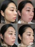  Tretinoin Acnelyse 0.05% / 0.1% – 20g chính hãng - da mụn nám 