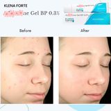  Kem mụn Klenaa Forte 0.1 - 0.3 %, Cham mun giúp cải thiện mụn ẩn, mụn đỏ, mờ thâm chính hãng-30g Chi hcm 