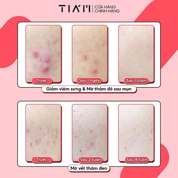 Kem Chấm Mụn Giảm Mụn Mờ Thâm Liền Sẹo Tia'm AC Fighting Spot RX Cream 30g