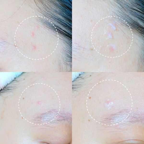 Trị Mụn Differine Adapalene Cream 0.1% 30g