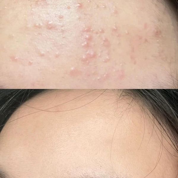 Trị Mụn Differine Adapalene Cream 0.1% 30g