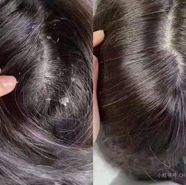 Dầu Gội Selsun Ngừa Gàu & Giảm Ngứa Da Đầu 100ml 1% Selenium Sulfide Anti-Dandruff Shampoo