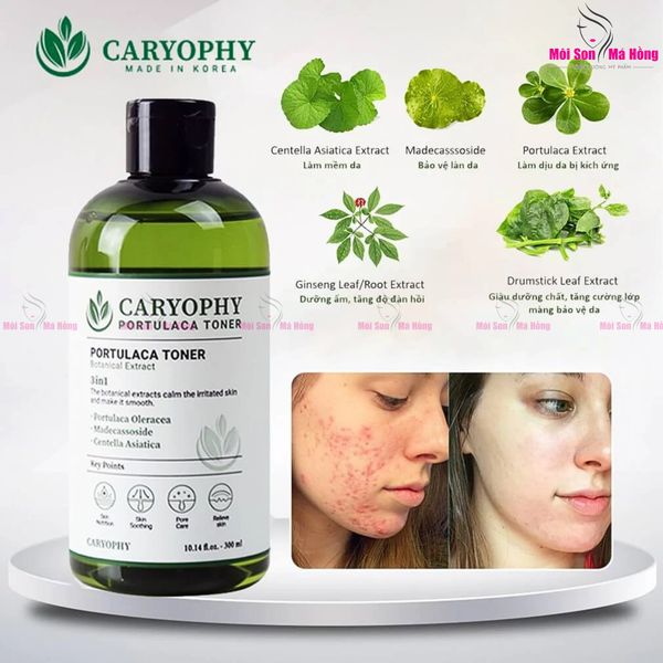 Nước Hoa Hồng Caryophy Ngừa Mụn Kiềm Dầu Giảm Thâm 300ml Portulaca Toner