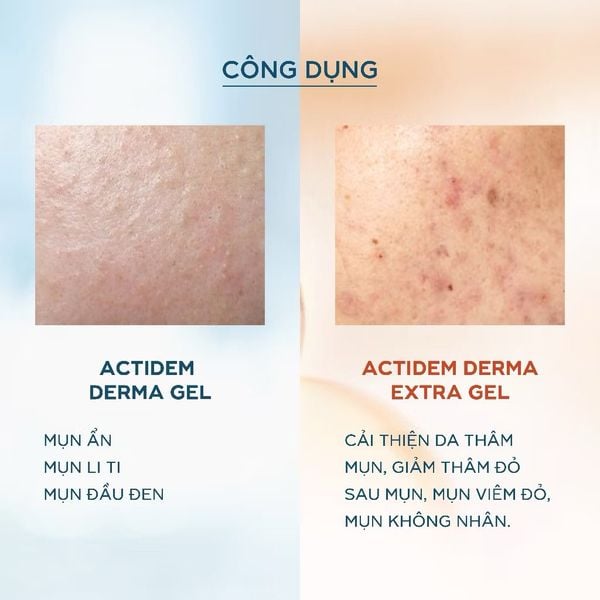 Gel Giảm Mụn, Thâm Actidem Derma Extra Gel 18g