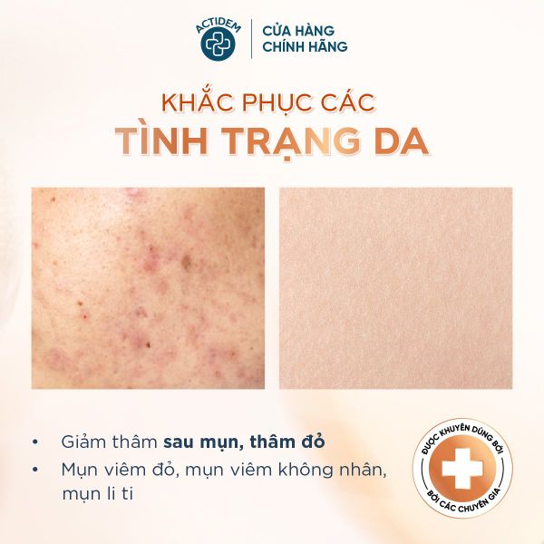 Gel Giảm Mụn, Thâm Actidem Derma Extra Gel 18g