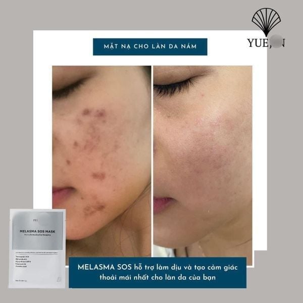 Mặt Nạ Yuejin Melasma Sos Mask Dưỡng Trắng, Mờ Thâm Nám 25ml