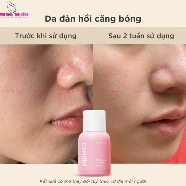 Hoạt Chất Chống Lão Hóa Candid Retinol Treatment 30ml