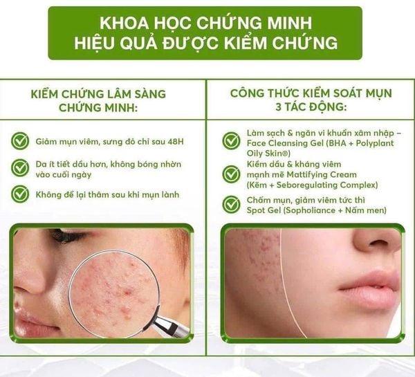 Tinh Chất Floslek Anti Acne Soothing Serum 50ml