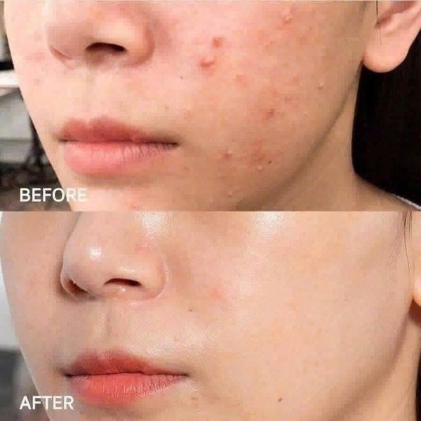 (CÔNG TY) Chấm Mụn Floslek Anti Acne Spot Gel For Imperfections 20ml