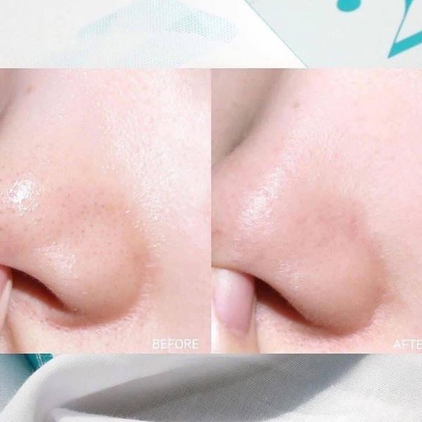 Dụng Cụ Làm Sạch Mụn Đầu Đen ILSO Deep Clean Master