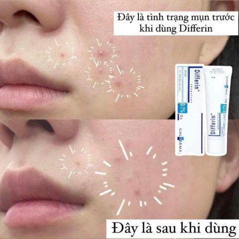 Trị Mụn Differine Adapalene Cream 0.1% 30g