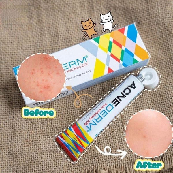 Kem Trị Mụn, Mờ Thâm Acne Derm Kwas Azelainowy 20% 20gr
