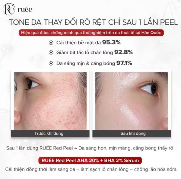 Tinh Chất Serum Peel Da RUÉE Red Peel Whitening Serum 30ml – Chăm Sóc Da Hằng Ngày