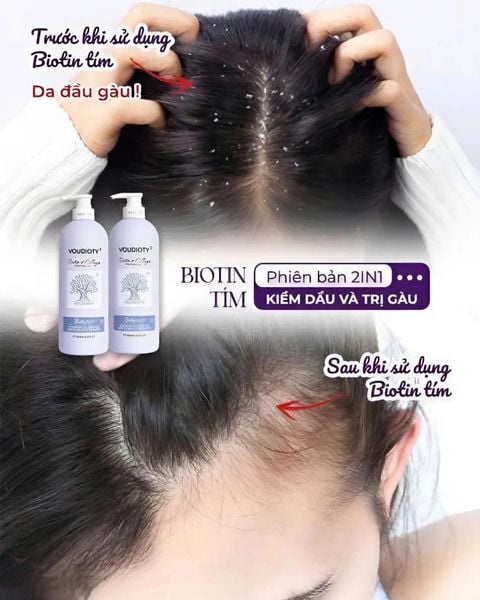 Bộ Dầu Gội Và Dầu Xả 2in1 Trị Gàu & Kiềm Dầu Biotin & Collagen Voudioty 1000ml (Tím)