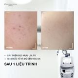  Liệu trình Laser Pico DeepFrac 