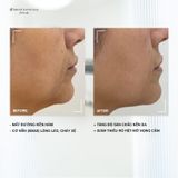  Liệu trình Láb V-Shape 