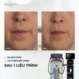  Liệu trình Láb Tightening Prime 