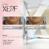  Liệu trình XERF 