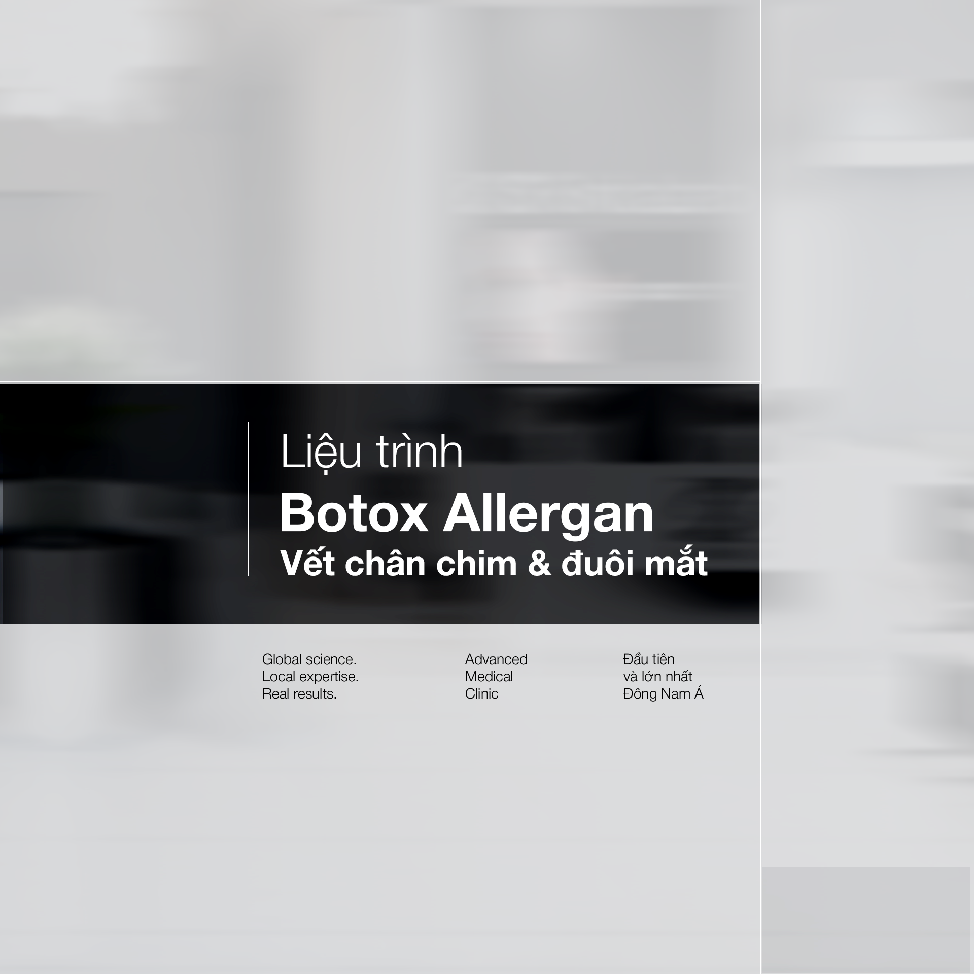  Liệu trình Botox Allergan Vết chân chim/đuôi mắt 