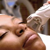  Liệu trình Ultherapy Prime - Toàn mặt 