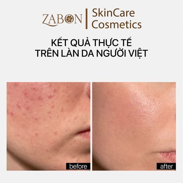 Tinh Chất Transparent Lab Oil Patrol Serum kiểm soát dầu, hỗ trợ làm mịn da 30ml