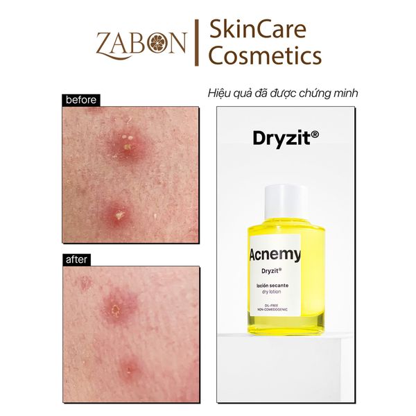 Dung dịch chấm mụn ACNEMY DRYZIT SPOT DRYING LOTION 30ml