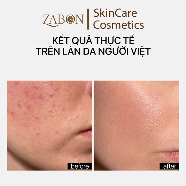 Sữa rửa mặt TRANSPARENT BLEMISH CONTROL BHA CLEANSER PH 3.5 kiểm soát mụn 150ml