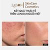 Sữa rửa mặt TRANSPARENT BLEMISH CONTROL BHA CLEANSER PH 3.5 kiểm soát mụn 150ml