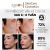 Tẩy tế bào chết kiểm soát mụn, giảm viêm và giảm tiết dầu MD CARE AntiAc Exfo 10ml (mini size)