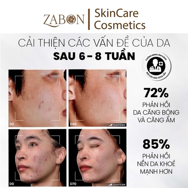 Tẩy tế bào chết kiểm soát mụn, giảm viêm và giảm tiết dầu MD CARE AntiAc Exfo 30ml